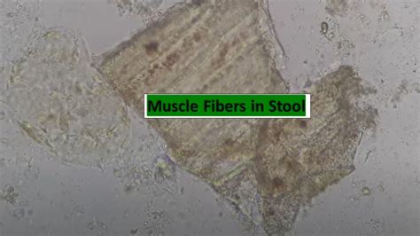 Muscle Fibers in Stool - YouTube