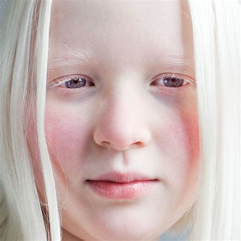 ALBINOs & THE TROUBLES THEY FACE.... - HearSayGh