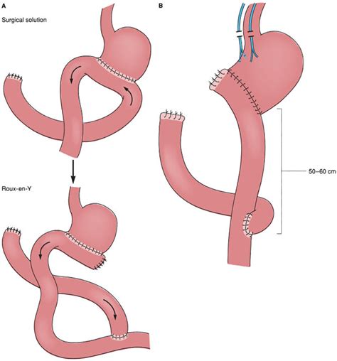 Roux-En-Y Gastrojejunostomy for Stomach Cancer