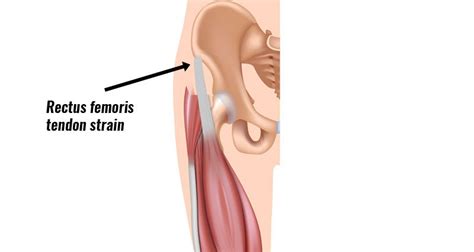 Rectus Femoris Tendon Strain - Symptoms, Causes, Treatment & Rehab