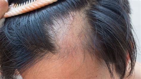 Alopecia Areata: Causes, Symptoms, Management and Clinical Features