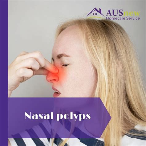 Nasal polyps symptoms and causes – Artofit