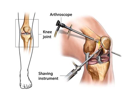 ACL Reconstruction | OrthoSport Victoria