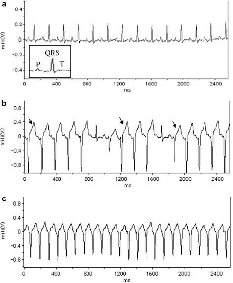 Examples of normal heart rhythm (a) and commonly occurring ventricular ...