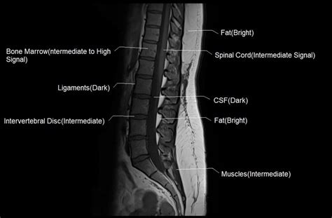 T1 vs T2 MRI | T1and T2 MRI image comparison