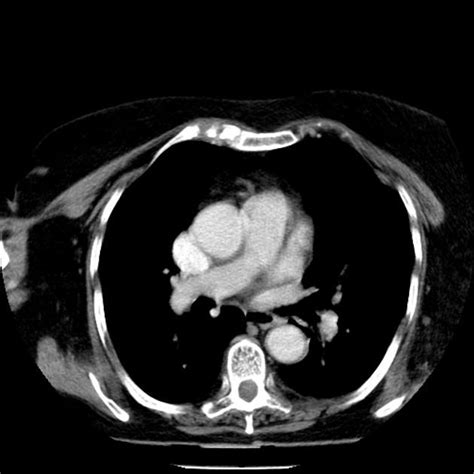 Retrosternal goitre: Both thyroid lobes are enlarged more on the left ...