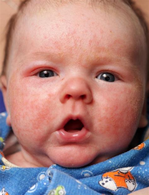 What are the Most Common Symptoms of a Baby Eye Infection?