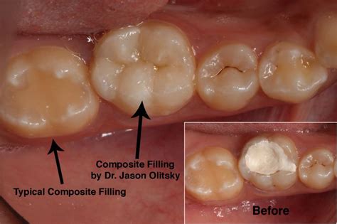 White Fillings - Smilestylist