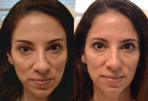 Upper Eyelid Images Of Eyelid Surgery Covered By Insurance : Blepharoplasty Annapolis Eyelid ...