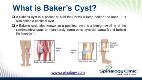 Bakers cyst symptoms, causes, diagnosis, & treatment