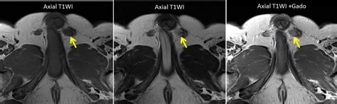 Testicular seminoma – Radiology Cases