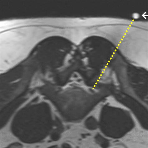 Axial T2-weighted MRI image of 43-year-old man with suspected left L5... | Download Scientific ...