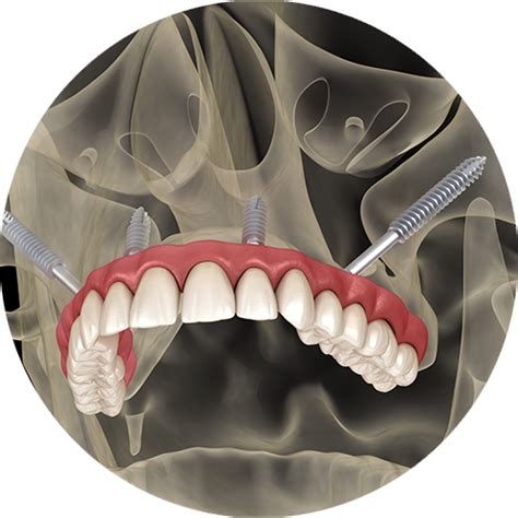 Zygomatic Implants | Provo, UT | Sundance Implant and Periodontal Center