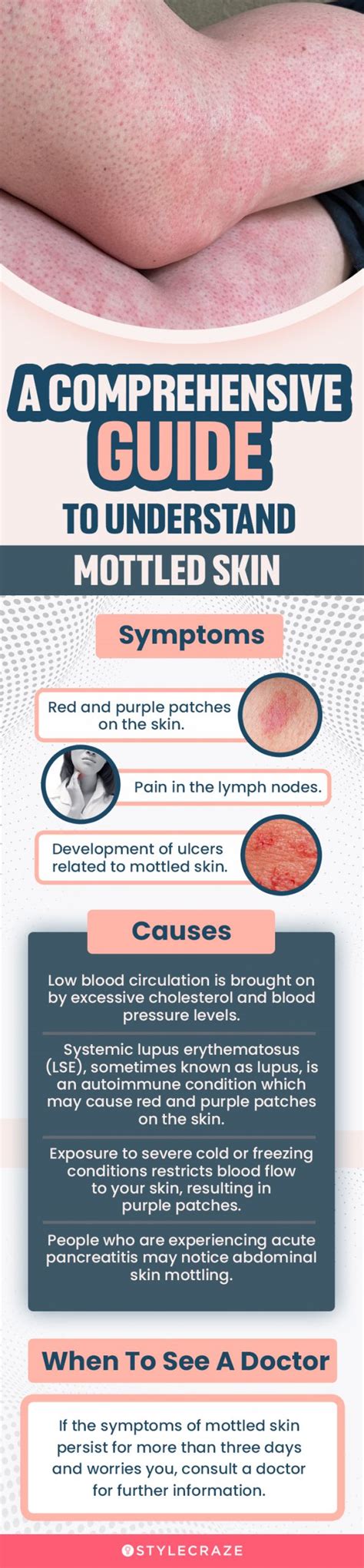 Mottled Skin: Causes, Symptoms, Diagnosis, 20 Best