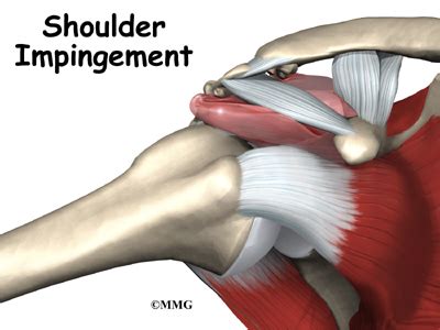 Impingement Syndrome