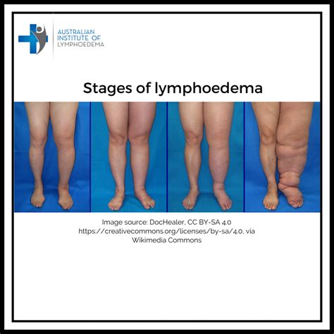 How is the severity of lymphoedema defined? – Australian Institute of ...