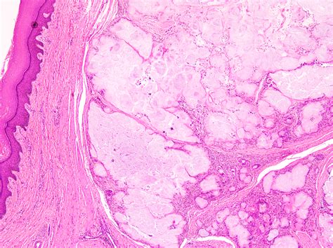 Tophus Histology