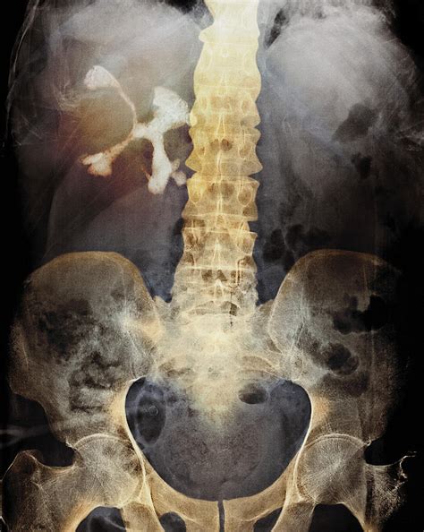 Staghorn Kidney Stone, X-ray Photograph by Du Cane Medical Imaging Ltd