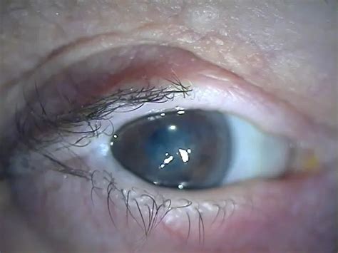 Lateral tarsorrhaphy - American Academy of Ophthalmology