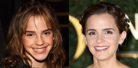 Celebrity Teeth Before And After