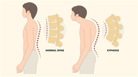 Understanding Dowager's Hump: Informative Pictures and Insights - Learn ...