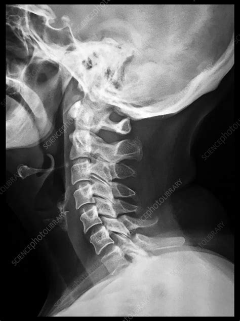 Healthy Cervical Spine Xray