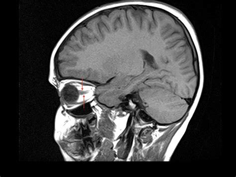 Acute lymphoblastic leukemia MRI - wikidoc