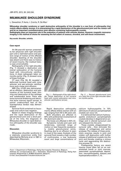 (PDF) Milwaukee shoulder syndrome