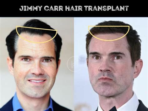 Jimmy Carr Hair Transplant - Hair Loss & Technical Analysis