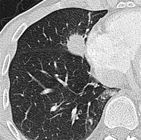 Tumors of the Lung | Radiology Key