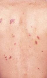 Cutaneous T-Cell Lymphoma Treatment | Favoriteplus.com Blog