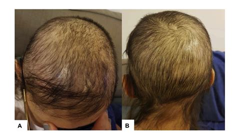 Oral Minoxidil for Permanent Chemotherapy Induced Alopecia — Donovan ...