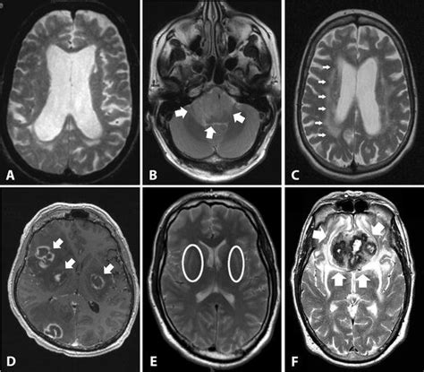 Secondary causes of parkinsonism. This figure shows examples of ...