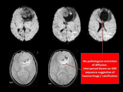 Olfactory neuroblastoma