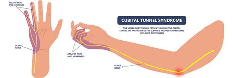 Cubital Tunnel Syndrome (Ulnar nerve compression) - Perth Orthopaedic Specialist Centre, ulnar nerve