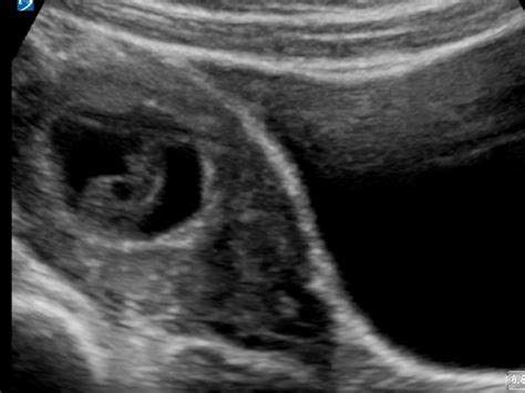 What Does A Miscarriage Ultrasound Look Like at melissadfpowell blog