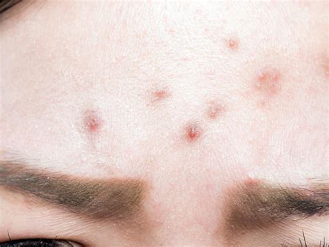 Bump on forehead: 7 causes and treatment