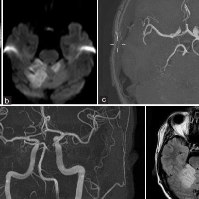 (a) MRI. T2 coronal view. Hemosiderine deposition into right hemisphere ...