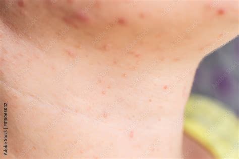 Red acne and a rash on a girl's face and neck, macro, hormone Stock ...