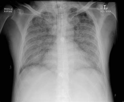 Ards Chest X Ray Findings