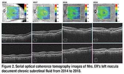 The Good and Bad of Retinal Fluid