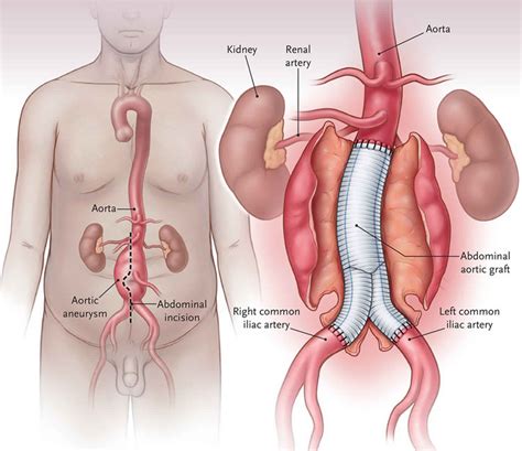 Abdominal aortic aneurysm, causes, symptoms, diagnosis & treatment