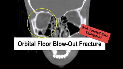 Blowout Fracture