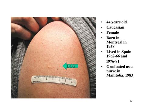 PPT - Recognition of BCG Scars PowerPoint Presentation - ID:3764793