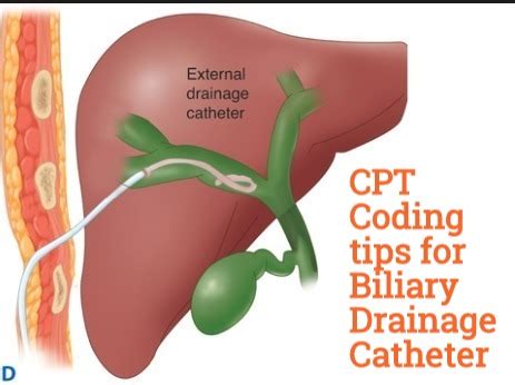 Coding guide for Biliary drainage catheter & Stent placement - Medical Coding Guide