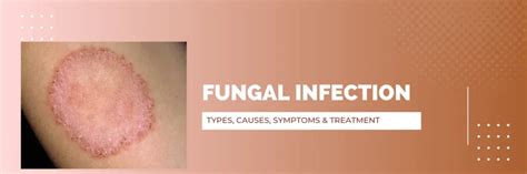 Fungal Infection Types, Causes, Symptoms & Treatment | USHC