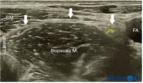 Ultrasound-Guided Fascia Iliaca Block - NYSORA