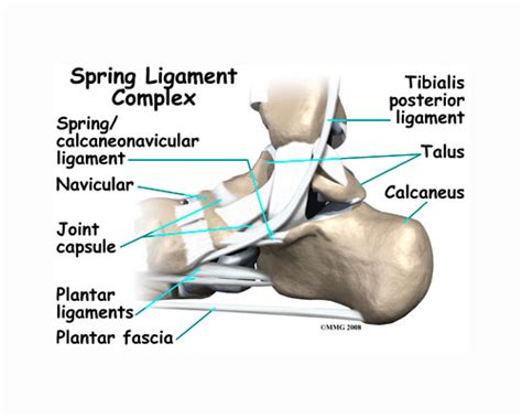 Lesión en el ligamento de Spring - Causas, síntomas y tratamiento