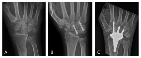 AAHS - Combined Treatment of Basal Thumb Arthritis and Scapholunate ...