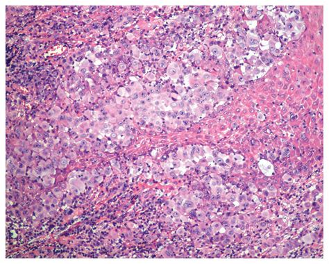 Nodular Melanoma Histology